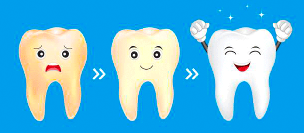 Teeth Whitening
