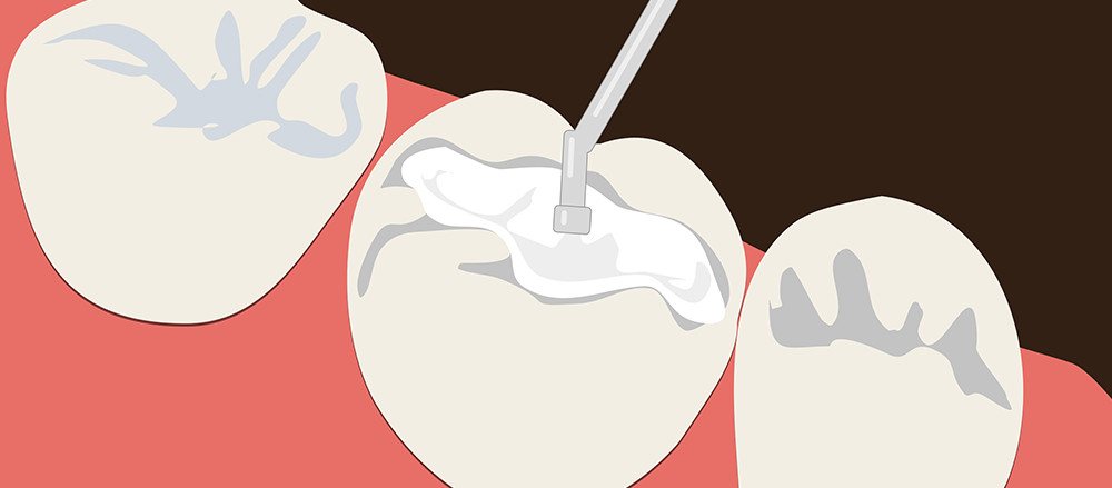 Composite Restoration pearl dental care sl