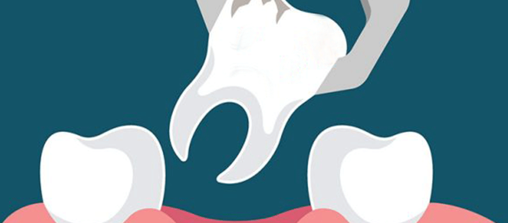 Tooth Extraction